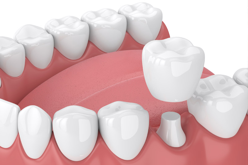 Dental Crowns in San Francisco