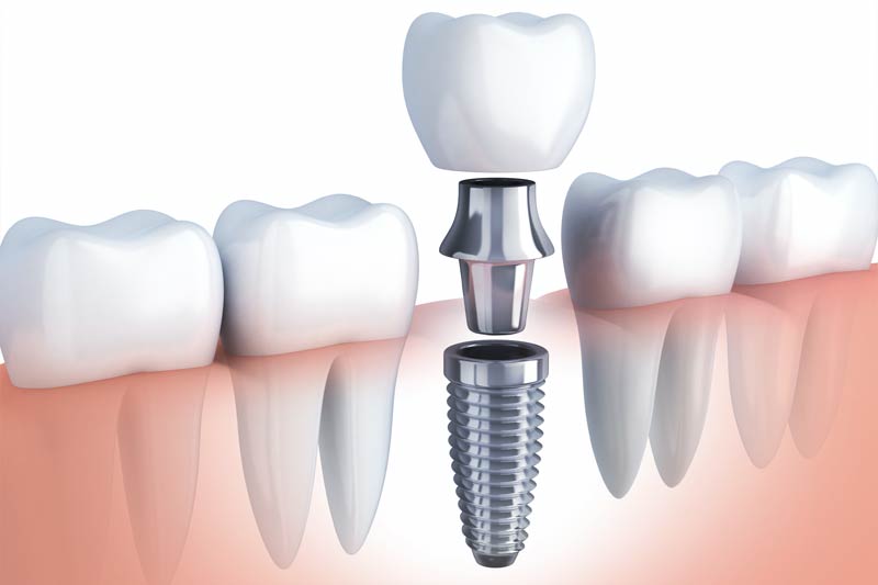 Implants Dentist in San Francisco