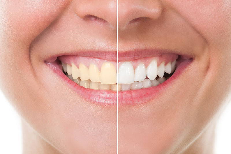 Teeth Whitening in San Francisco