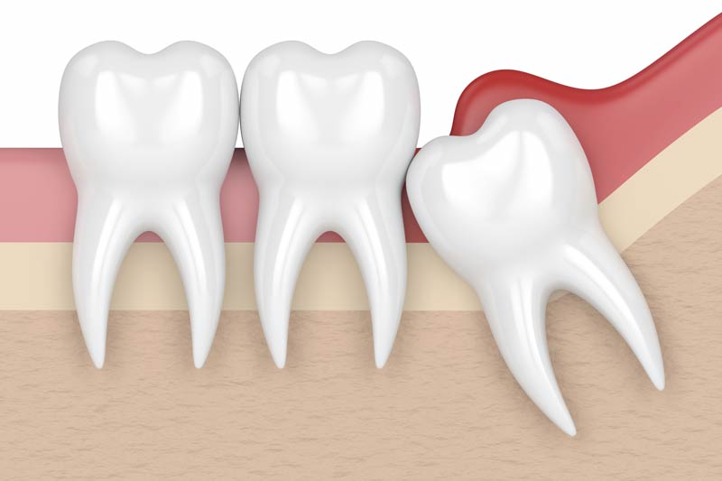 Wisdom Tooth Removal in San Francisco